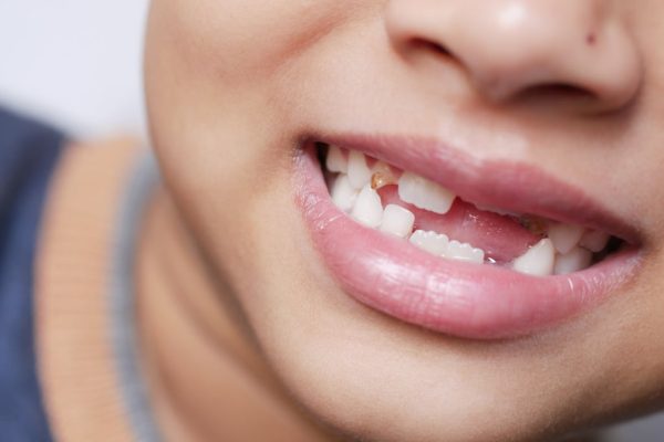 missing-teeth-pediatrics